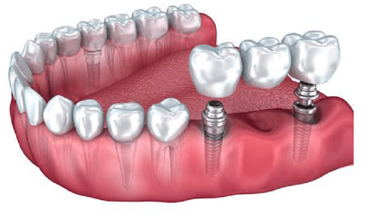 Comparaison des implants dentaires avec d'autres méthodes de remplacement dentaire | Le meilleur dentiste à Ispahan - le meilleur chirurgien des gencives à Ispahan - le prix des implants dentaires à Ispahan