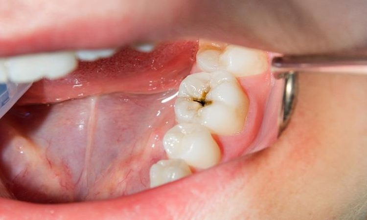 Traitement de la carie dentaire avec des méthodes mini-invasives | Le meilleur dentiste à Ispahan - le meilleur chirurgien des gencives à Ispahan - le prix des implants dentaires à Ispahan| Dr Hossein Borjian