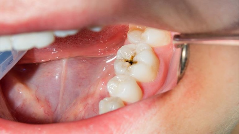 Treatment of tooth decay with minimally invasive methods | The best dentist in Isfahan - the best gum surgeon in Isfahan - the price of dental implants in Isfahan| Dr. Hossein Borjian