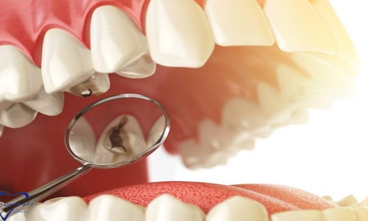 Comparaison des matériaux d'obturation dentaire anciens et nouveaux | Le meilleur dentiste à Ispahan - le meilleur chirurgien des gencives à Ispahan - le prix des implants dentaires à Ispahan| Dr Hossein Borjian