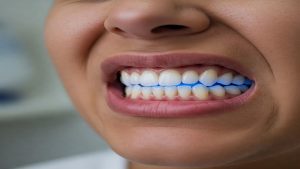 Effets secondaires possibles du blanchiment des dents |Le meilleur dentiste à Ispahan - le meilleur chirurgien des gencives à Ispahan - le prix des implants dentaires à Ispahan| Dr Hossein Borjian