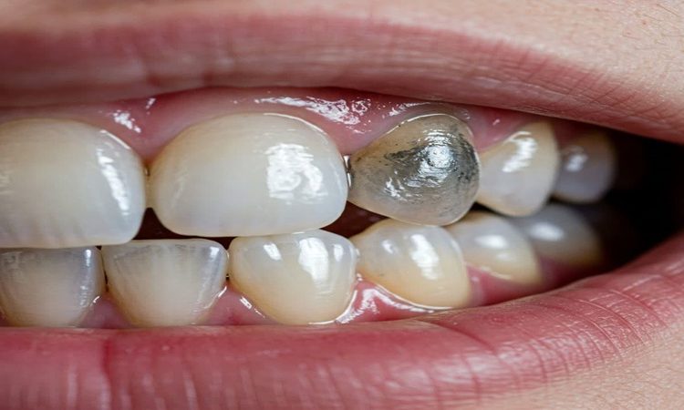محدودیت های سفید کردن دندان |بهترین دندانپزشک اصفهان-بهترین جراح لثه اصفهان-قیمت ایمپلنت دندان اصفهان| دکتر حسین برجیان