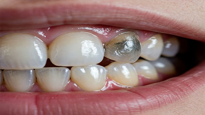محدودیت های سفید کردن دندان |Le meilleur dentiste à Ispahan - le meilleur chirurgien des gencives à Ispahan - le prix des implants dentaires à Ispahan| Dr Hossein Borjian