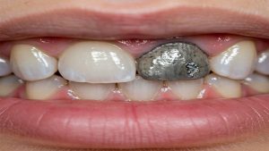 محدودیت های سفید کردن دندان |Le meilleur dentiste à Ispahan - le meilleur chirurgien des gencives à Ispahan - le prix des implants dentaires à Ispahan| Dr Hossein Borjian
