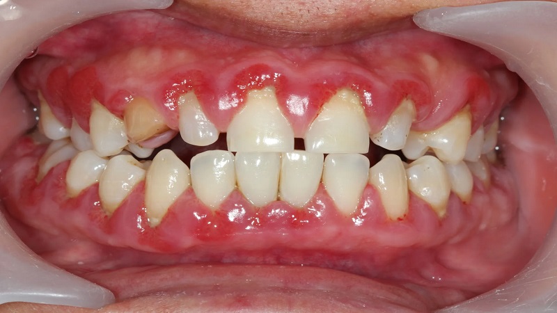 روش‌های جدید در تشخیص زودهنگام بیماری‌های لثه | Le meilleur dentiste à Ispahan - le meilleur chirurgien des gencives à Ispahan - le prix des implants dentaires à Ispahan| Dr Hossein Borjian