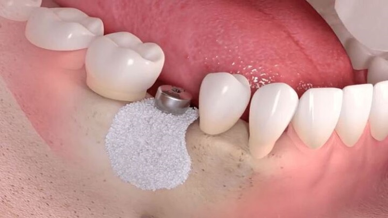 پیوند استخوان با استفاده از گراف‌های مصنوعی | The best dentist in Isfahan - the best gum surgeon in Isfahan - the price of dental implants in Isfahan| Dr. Hossein Borjian