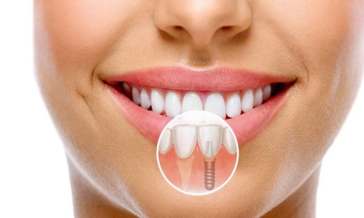 نقش تکنولوژی در بهبود روش‌های جراحی لثه و ایمپلنت |بهترین دندانپزشک ا اصفهان-بهترین جراح لثه اصفهان-قیمت ایمپلنت دندان اصفهان