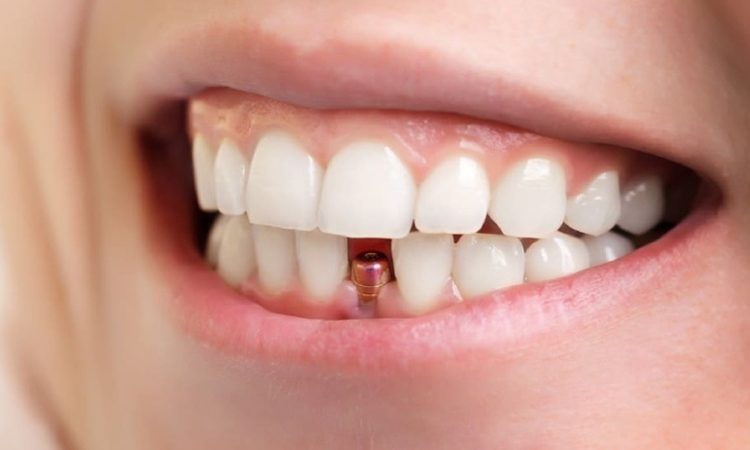 The best dentist in Isfahan - the best gum surgeon in Isfahan - the price of dental implants in Isfahan| Dr. Hossein Borjian