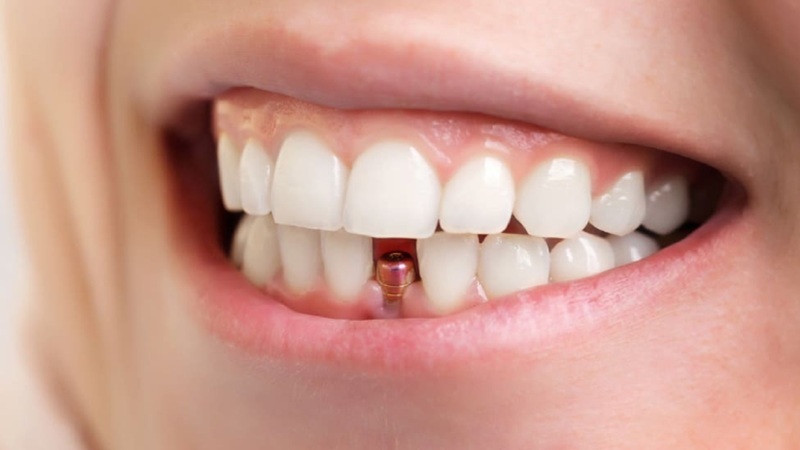 The best dentist in Isfahan - the best gum surgeon in Isfahan - the price of dental implants in Isfahan| Dr. Hossein Borjian
