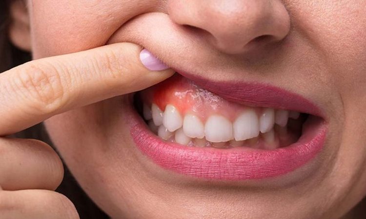 جلوگیری از پیشرفت بیماری‌های لثه | دکتر حسین برجیان (بهترین دندانپزشک اصفهان-بهترین جراح لثه اصفهان-بهترین دندانپزشک زیبایی اصفهان)
