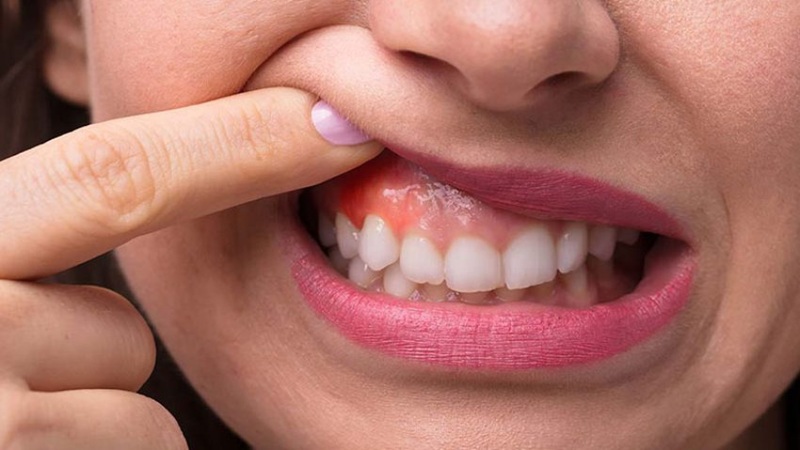 جلوگیری از پیشرفت بیماری‌های لثه | Dr. Hossein Borjian (The best dentist in Isfahan - the best gum surgeon in Isfahan - the best cosmetic dentist in Isfahan)