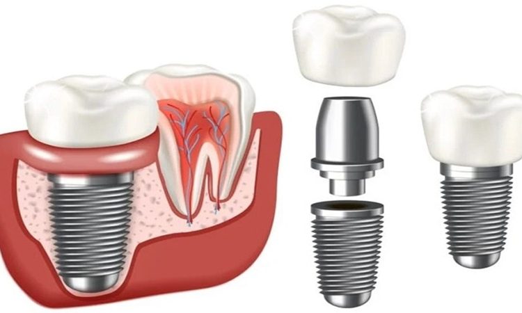 Compare the types of dental implants | The best dentist in Isfahan - the best gum surgeon in Isfahan - the price of dental implants in Isfahan| Dr. Hossein Borjian