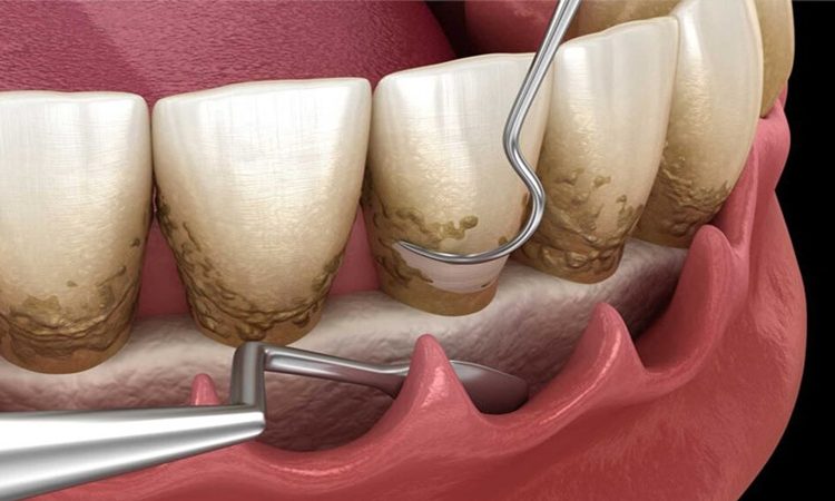 بهترین دندانپزشک اصفهان-بهترین جراح لثه اصفهان-قیمت ایمپلنت دندان اصفهان| دکتر حسین برجیان