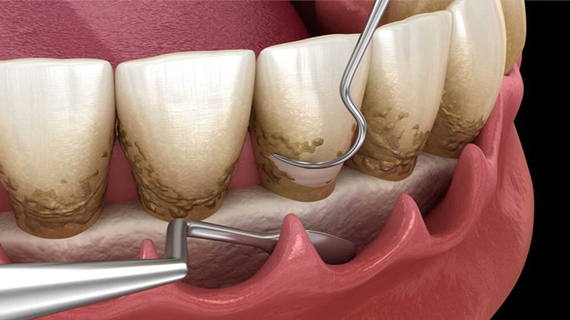 Le meilleur dentiste à Ispahan - le meilleur chirurgien des gencives à Ispahan - le prix des implants dentaires à Ispahan| Dr Hossein Borjian