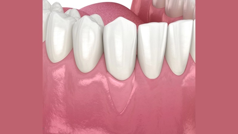 مقایسه روش‌های مختلف پیوند بافت نرم در جراحی‌های پیش پروتزی | بهترین دندانپزشک اصفهان-بهترین جراح لثه اصفهان-قیمت ایمپلنت دندان اصفهان| دکتر حسین برجیان