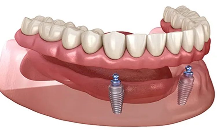 نقش پروتزهای موقت در فرآیند ایمپلنت دندانی | The best dentist in Isfahan - the best gum surgeon in Isfahan - the price of dental implants in Isfahan| Dr. Hossein Borjian