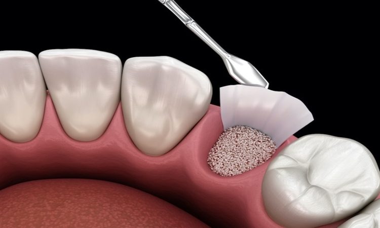 ارزیابی نیاز به پیوند استخوان در جراحی‌های پیش پروتزی | بهترین دندانپزشک اصفهان-بهترین جراح لثه اصفهان-قیمت ایمپلنت دندان اصفهان| دکتر حسین برجیان