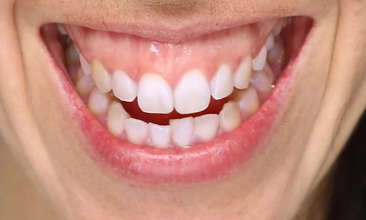 اصلاح لبخند لثه‌ای | بهترین دندانپزشک اصفهان-بهترین جراح لثه اصفهان-قیمت ایمپلنت دندان اصفهان| دکتر حسین برجیان