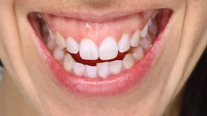 اصلاح لبخند لثه‌ای | بهترین دندانپزشک اصفهان-بهترین جراح لثه اصفهان-قیمت ایمپلنت دندان اصفهان| دکتر حسین برجیان