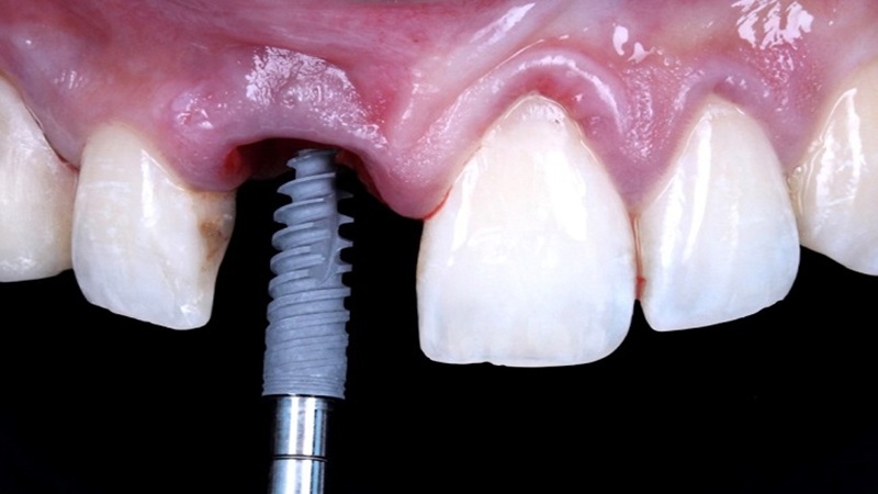 مزایا و معایب ایمپلنت‌های فوری | بهترین دندانپزشک اصفهان-بهترین جراح لثه اصفهان-قیمت ایمپلنت دندان اصفهان| دکتر حسین برجیان