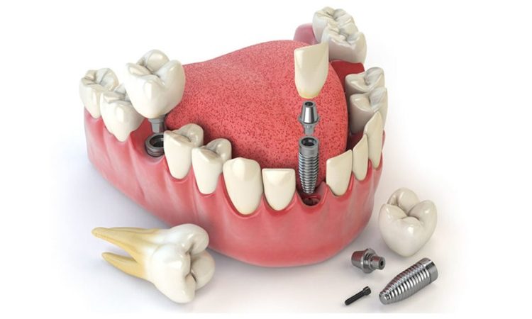 استفاده از ایمپلنت‌های فوری در جراحی‌های پیش پروتزی | بهترین دندانپزشک اصفهان-بهترین جراح لثه اصفهان-قیمت ایمپلنت دندان اصفهان| دکتر حسین برجیان