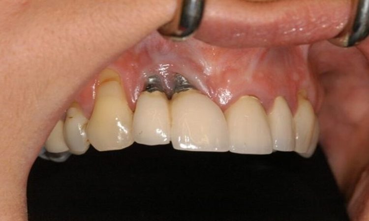 روش‌های پیشگیری از عفونت بعد از جراحی ایمپلنت دندانی | بهترین دندانپزشک اصفهان-بهترین جراح لثه اصفهان-قیمت ایمپلنت دندان اصفهان| دکتر حسین برجیان