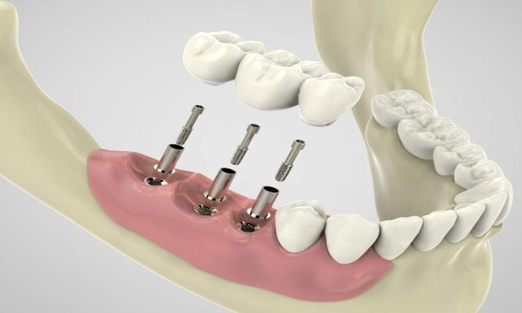 روش‌های پیشرفته در ارزیابی کیفیت استخوان برای ایمپلنت دندانی | The best dentist in Isfahan - the best gum surgeon in Isfahan - the price of dental implants in Isfahan| Dr. Hossein Borjian