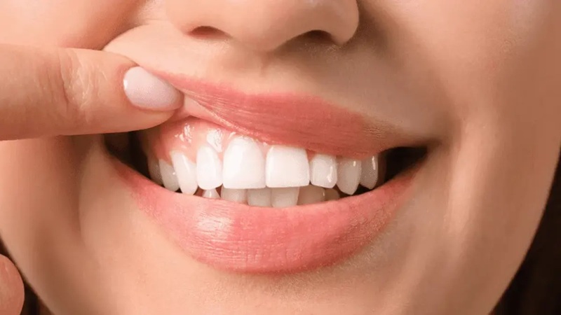 درمان التهاب لثه | Dr. Hossein Borjian (The best dentist in Isfahan - the best gum surgeon in Isfahan - the best cosmetic dentist in Isfahan)