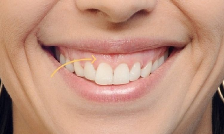 لبخند لثه‌ای | بهترین دندانپزشک اصفهان-بهترین جراح لثه اصفهان-قیمت ایمپلنت دندان اصفهان| دکتر حسین برجیان