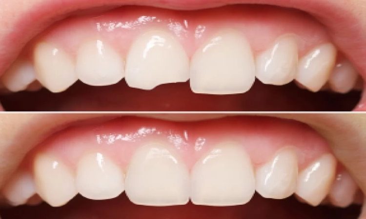 استفاده از مواد کامپوزیت در ترمیم‌های زیبایی دندان | بهترین دندانپزشک اصفهان-بهترین جراح لثه اصفهان-قیمت ایمپلنت دندان اصفهان| دکتر حسین برجیان