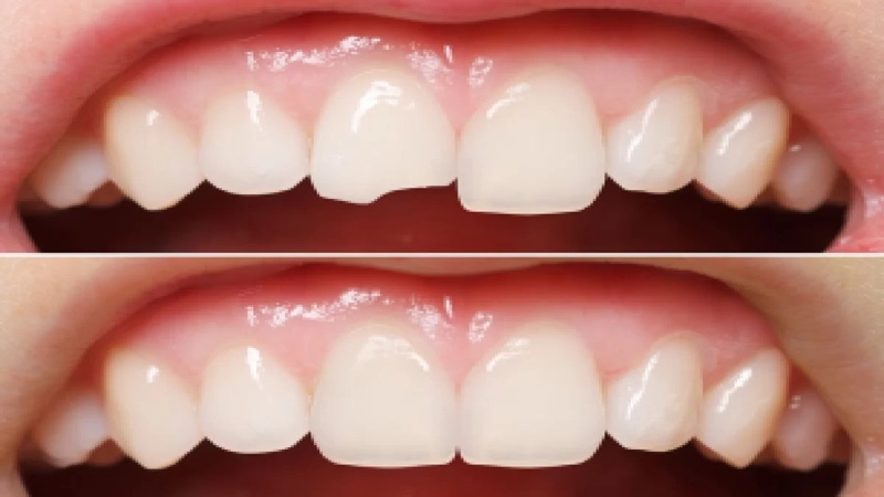 استفاده از مواد کامپوزیت در ترمیم‌های زیبایی دندان | بهترین دندانپزشک اصفهان-بهترین جراح لثه اصفهان-قیمت ایمپلنت دندان اصفهان| دکتر حسین برجیان