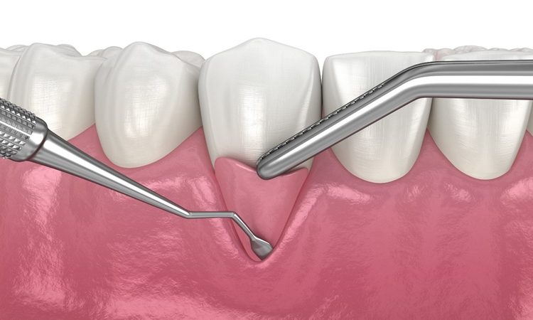 تحقیقات جدید در زمینه ترمیم بافت لثه و استخوان | بهترین دندانپزشک اصفهان-بهترین جراح لثه اصفهان-قیمت ایمپلنت دندان اصفهان| دکتر حسین برجیان