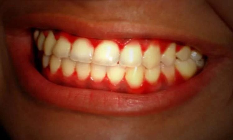 رابطه بین بیماری‌های لثه و دیابت | بهترین دندانپزشک اصفهان-بهترین جراح لثه اصفهان-قیمت ایمپلنت دندان اصفهان| دکتر حسین برجیان