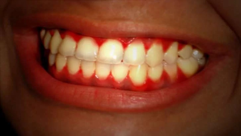 رابطه بین بیماری‌های لثه و دیابت | بهترین دندانپزشک اصفهان-بهترین جراح لثه اصفهان-قیمت ایمپلنت دندان اصفهان| دکتر حسین برجیان