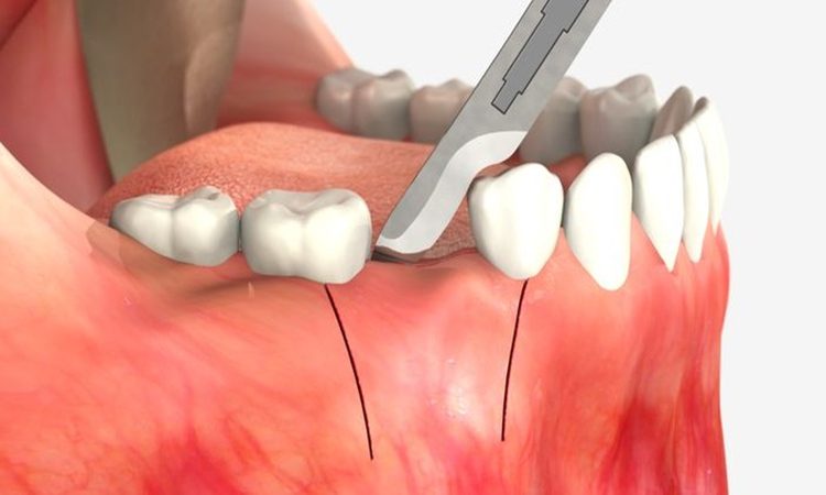 روش‌های نوین در جراحی لثه | بهترین دندانپزشک اصفهان-بهترین جراح لثه اصفهان-قیمت ایمپلنت دندان اصفهان| دکتر حسین برجیان