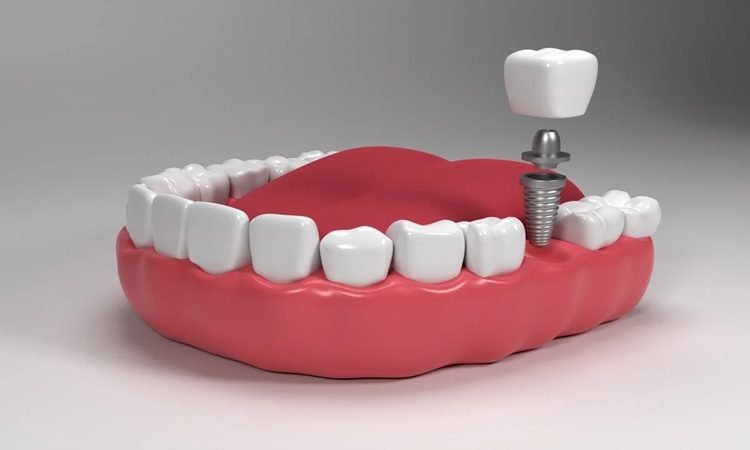 نقش ایمپلنت دندان در بهبود کیفیت زندگی بیماران | بهترین دندانپزشک اصفهان-بهترین جراح لثه اصفهان-قیمت ایمپلنت دندان اصفهان| دکتر حسین برجیان