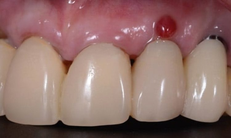 نقش باکتری‌ها در عفونت ایمپلنت دندانی | بهترین دندانپزشک اصفهان-بهترین جراح لثه اصفهان-قیمت ایمپلنت دندان اصفهان| دکتر حسین برجیان