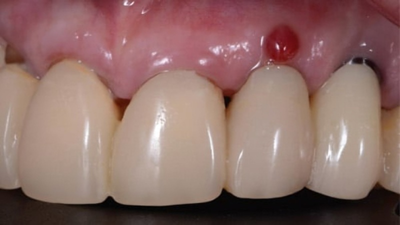 نقش باکتری‌ها در عفونت ایمپلنت دندانی | بهترین دندانپزشک اصفهان-بهترین جراح لثه اصفهان-قیمت ایمپلنت دندان اصفهان| دکتر حسین برجیان