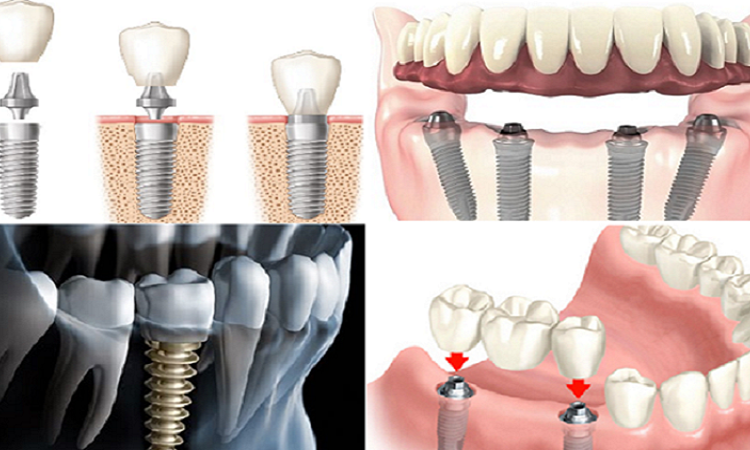 چگونه انتخاب بهترین نوع ایمپلنت برای هر بیمار انجام می‌شود؟ | بهترین دندانپزشک اصفهان-بهترین جراح لثه اصفهان-قیمت ایمپلنت دندان اصفهان| دکتر حسین برجیان