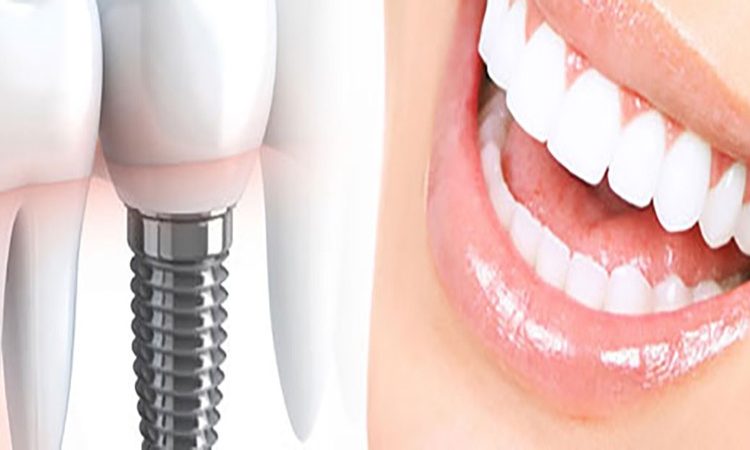ایمپلنت دندانی و تأثیر آن بر زیبایی صورت | بهترین دندانپزشک اصفهان-بهترین جراح لثه اصفهان-قیمت ایمپلنت دندان اصفهان| دکتر حسین برجیان