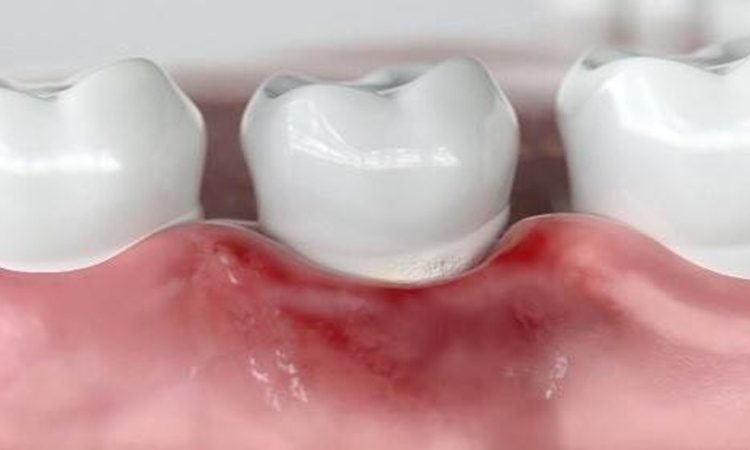 تأثیر بیماری‌های سیستمیک بر نتیجه جراحی لثه | بهترین دندانپزشک اصفهان-بهترین جراح لثه اصفهان-قیمت ایمپلنت دندان اصفهان| دکتر حسین برجیان