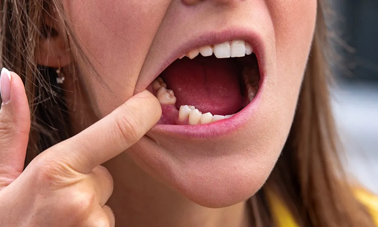 بهترین گزینه برای جایگزینی دندان‌های از دست رفته | بهترین دندانپزشک اصفهان-بهترین جراح لثه اصفهان-قیمت ایمپلنت دندان اصفهان| دکتر حسین برجیان