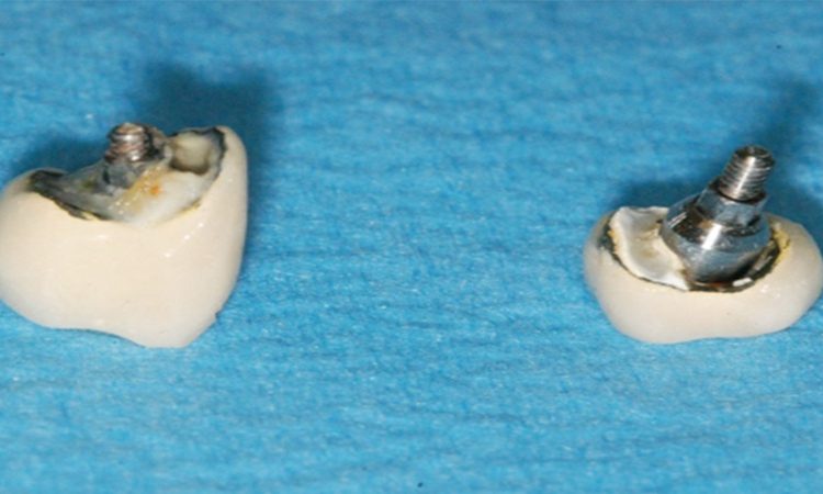 عوامل مؤثر در شکست ایمپلنت دندانی | بهترین دندانپزشک اصفهان-بهترین جراح لثه اصفهان-قیمت ایمپلنت دندان اصفهان| دکتر حسین برجیان