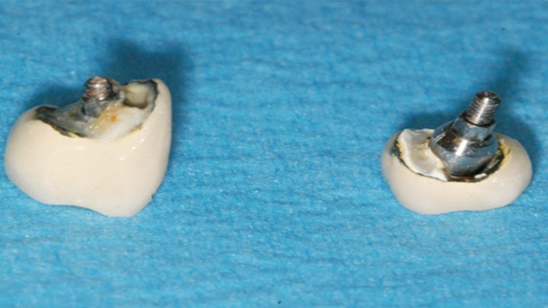 عوامل مؤثر در شکست ایمپلنت دندانی | بهترین دندانپزشک اصفهان-بهترین جراح لثه اصفهان-قیمت ایمپلنت دندان اصفهان| دکتر حسین برجیان