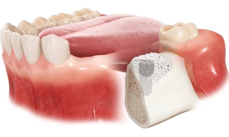 انواع، روش‌ها و مقایسه منابع مختلف پیوند استخوان | بهترین دندانپزشک اصفهان-بهترین جراح لثه اصفهان-قیمت ایمپلنت دندان اصفهان| دکتر حسین برجیان