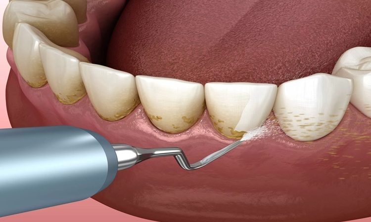 آیا جرم‌گیری دندان ضرر دارد؟ | دکتر حسین برجیان (بهترین دندانپزشک اصفهان-بهترین جراح لثه اصفهان-بهترین دندانپزشک زیبایی اصفهان)