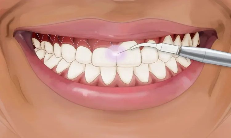 نتیجه نهایی لیفت لثه | بهترین دندانپزشک اصفهان-بهترین جراح لیفت لثه اصفهان-قیمت ایمپلنت دندان اصفهان| دکتر حسین برجیان