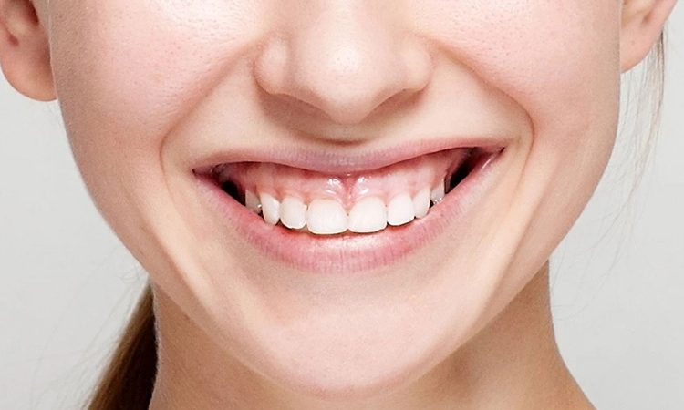 دلایل ایجاد لبخند لثه‌ای | بهترین دندانپزشک اصفهان-بهترین جراح لیفت لثه اصفهان-قیمت ایمپلنت دندان اصفهان| دکتر حسین برجیان