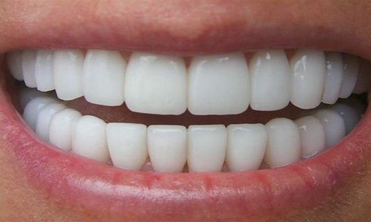 لمینت سرامیکی بهتر است یا کامپوزیت ونیر؟ | دکتر حسین برجیان (بهترین دندانپزشک اصفهان-بهترین جراح لثه اصفهان-بهترین دندانپزشک زیبایی اصفهان)