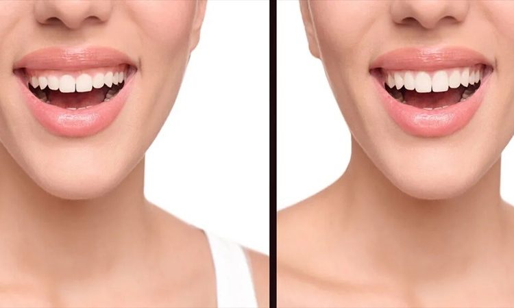 تفاوت لیفت لثه با لیزر و جراحی سنتی | بهترین دندانپزشک اصفهان-بهترین جراح لیفت لثه اصفهان-قیمت ایمپلنت دندان اصفهان| دکتر حسین برجیان